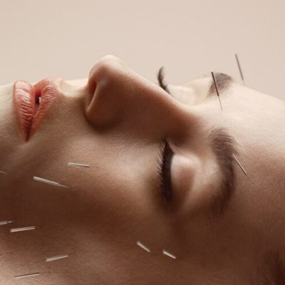 cosmetic-acupuncture_66_orig